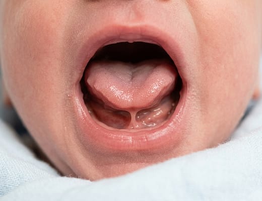 frenulo linguale corto neonato