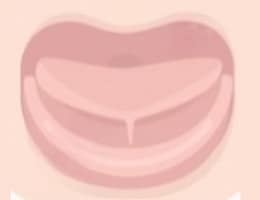 cosa fare frenulo linguale corto